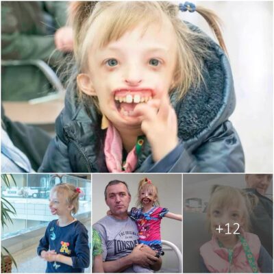 Witnessing a remarkable medical breakthrough: After making others ‘scared of hafl face’, she finally now can ‘learn to laugh’