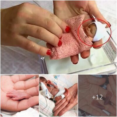 Introducing a Tiny Marvel: The World’s Smallest Newborn, Measuring a Mere 8.2 Inches and Weighing a Merely 230 Grams