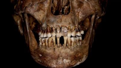 17th-century Frenchwoman’s gold dental work was likely torturous to her teeth